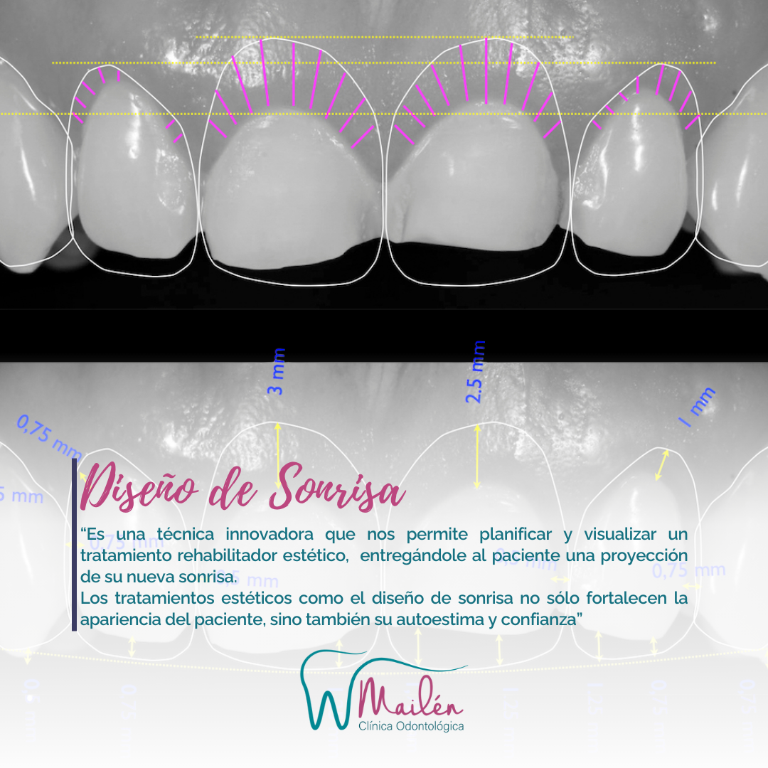 DISEÑO DE SONRISA