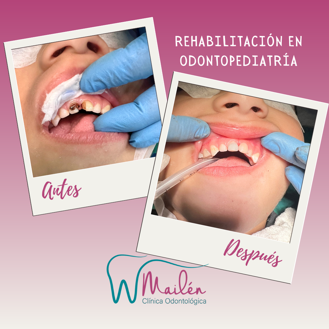 REHABILITACIÓN EN ODONTOPEDIATRÍA